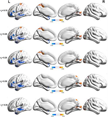 Abnormal Global Brain Functional Connectivity in Primary Insomnia Patients: A Resting-State Functional MRI Study